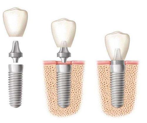 种植牙损坏