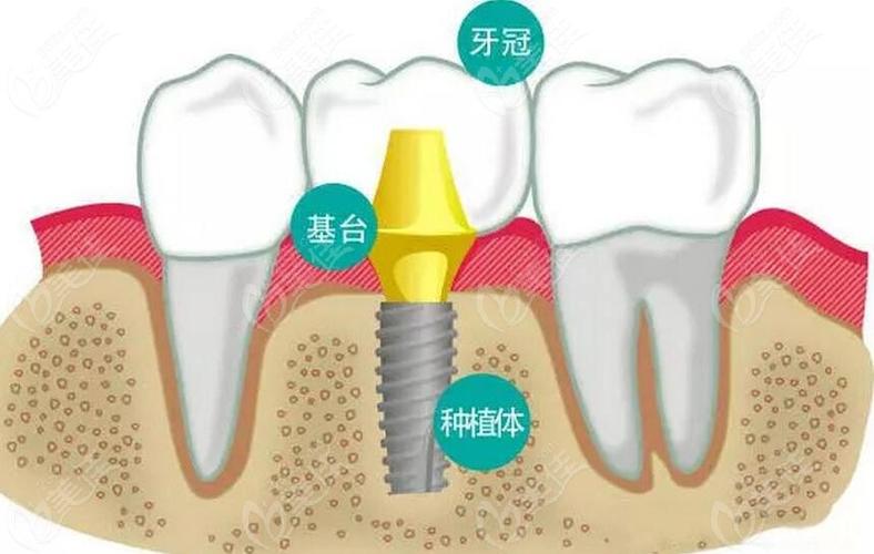 种植牙好在哪里