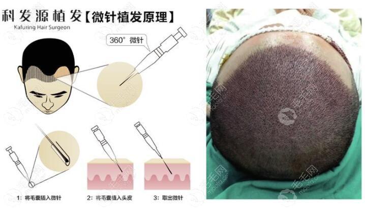 aio毛发种植技术