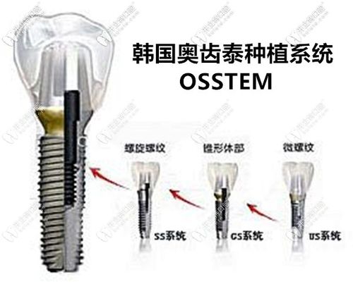 种植体表面处理技术