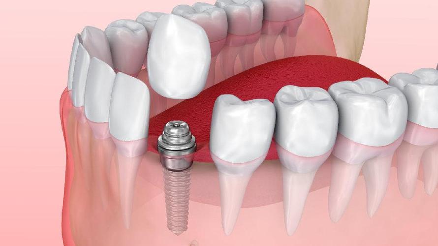 种植牙是什么概念