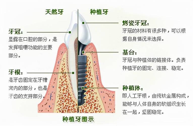 种植牙种的是什么牙