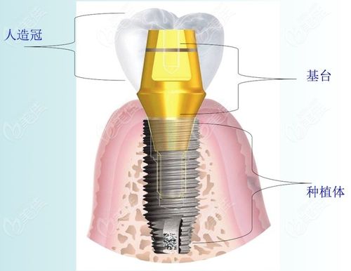 种植牙结构和材料