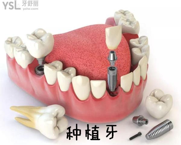 种植牙5000一颗贵吗